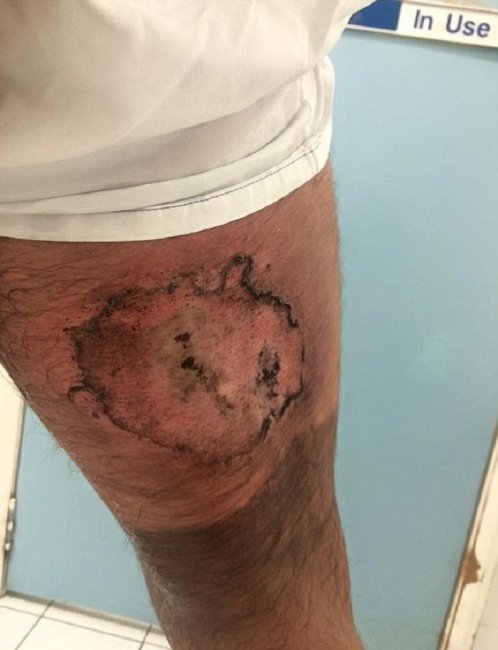 Загоревшийся iPhone поджарил задницу велосипедиста