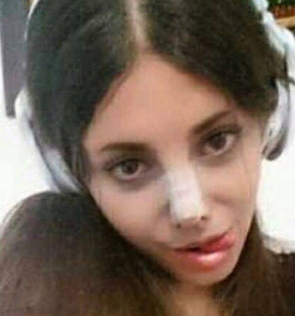 19-летней девушки из Ирана изуродовала себя в погоне стать похожей на Анджелину Джоли