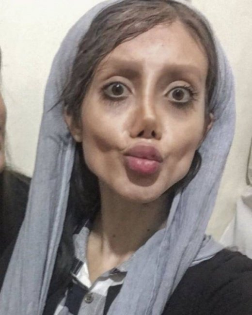 19-летней девушки из Ирана изуродовала себя в погоне стать похожей на Анджелину Джоли